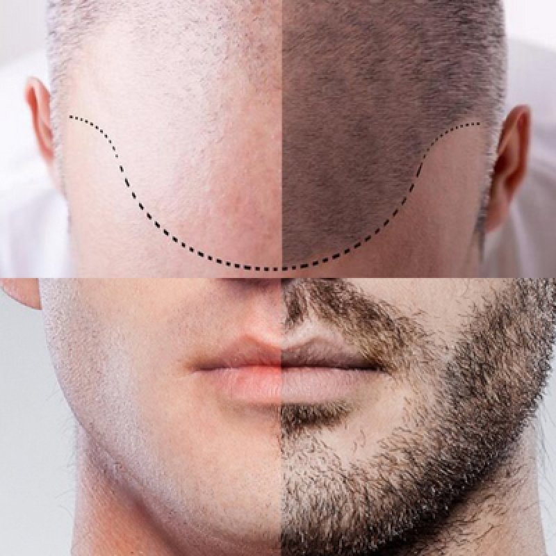 Hair Beard Transplantation