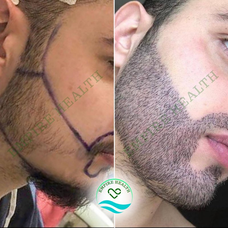 Hair Beard Transplantation