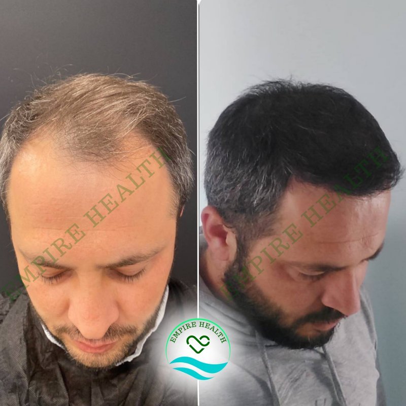 Hair Beard Transplantation