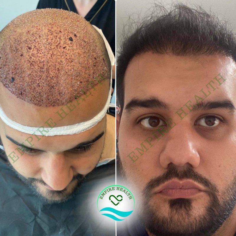 Hair Beard Transplantation