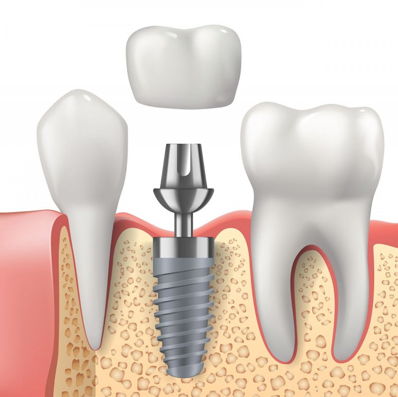 Implant Applications