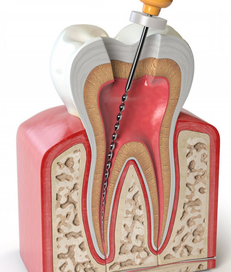 Endodontics (root canal treatment)