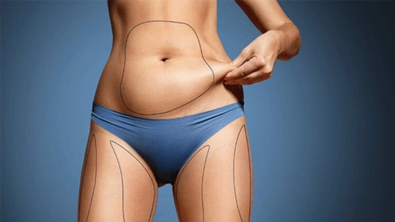 Liposuction