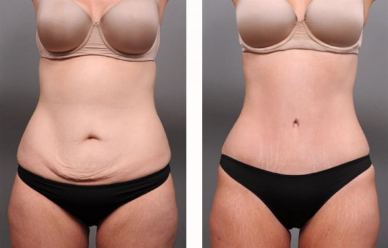 Tummy tuck 