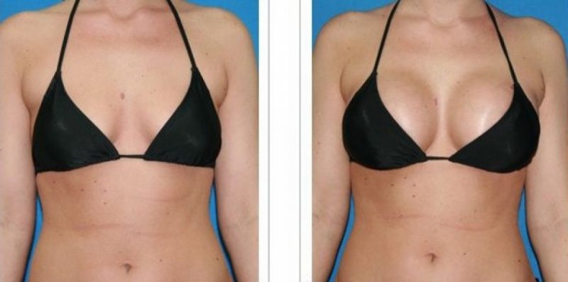 Breast Augmentation