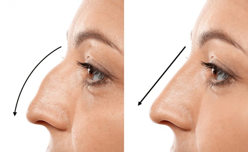 Rhinoplasty