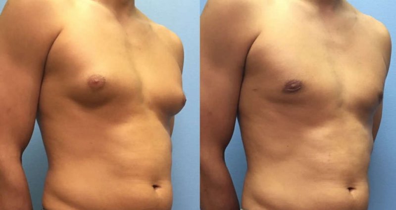 Gynecomastia