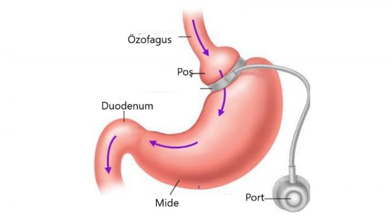 Gastric Band 