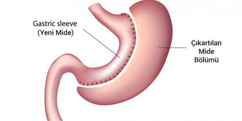 Gastric sleeve surgery 