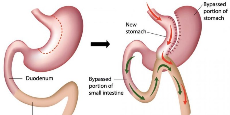 Mini gastric bypass