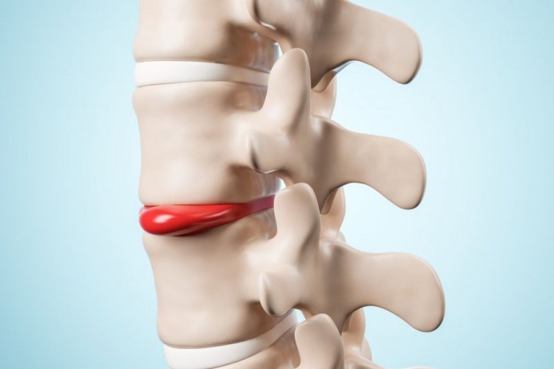 Herniated Disc 