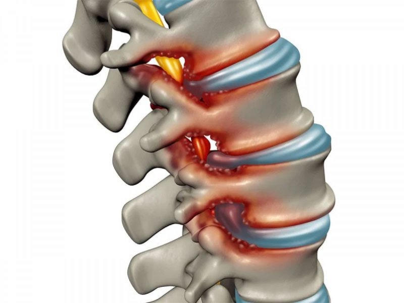 Lumbar spinal stenosis