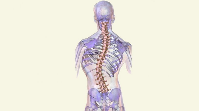 Scoliosis