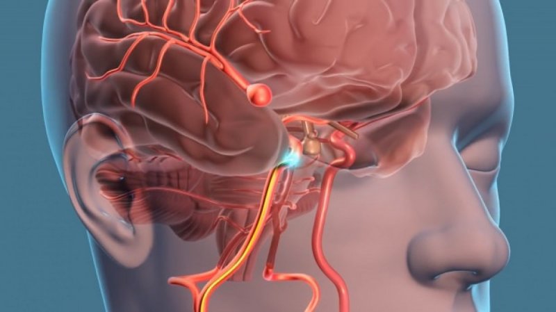 Brain Aneurysm