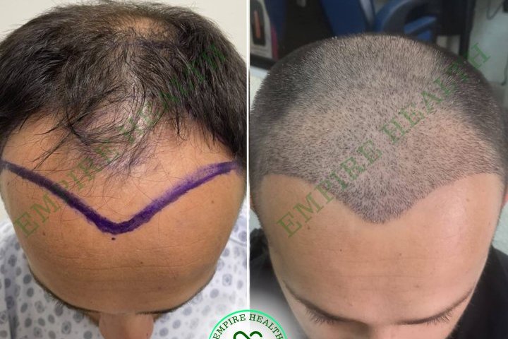 Hair Transplantation with DHI Method